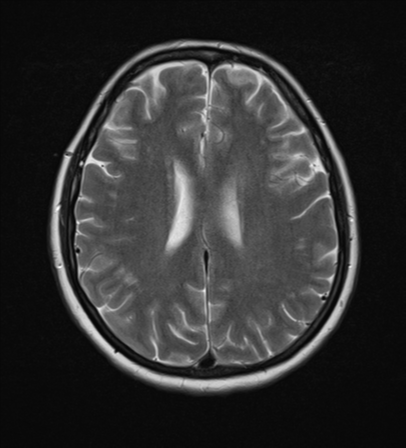 File:Cerebral metastases mimicking abscesses (Radiopaedia 45841-50131 Axial T2 19).png