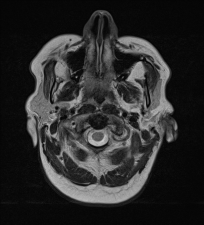 File:Cerebral metastases mimicking abscesses (Radiopaedia 45841-50131 Axial T2 2).png