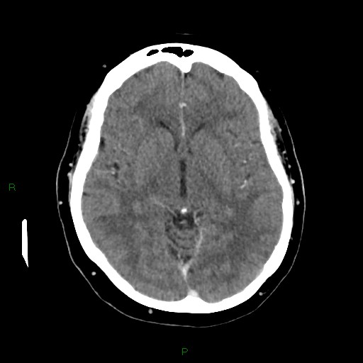 File:Cerebral metastasis from renal cell carcinoma (Radiopaedia 82306-96375 Axial C+ delayed 18).jpg