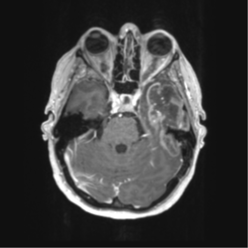 File:Cerebral metastasis mimicking glioblastoma (Radiopaedia 69155-78937 Axial T1 C+ 17).png