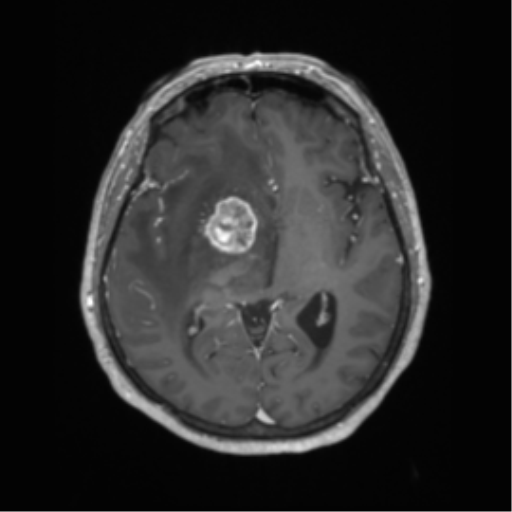 Cerebral metastasis to basal ganglia (Radiopaedia 81568-95413 Axial T1 C+ 34).png