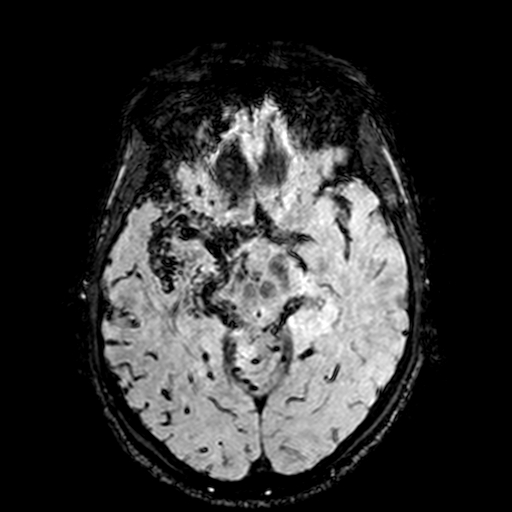 Cerebral parenchymal arteriovenous malformation (Radiopaedia 27280-27456 Axial SWI 44).jpg