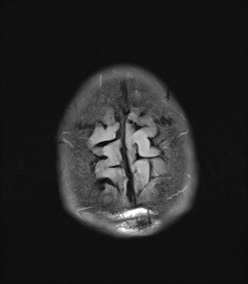 File:Cerebral toxoplasmosis (Radiopaedia 43956-47461 Axial FLAIR 21).jpg