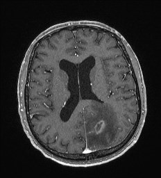 Cerebral toxoplasmosis (Radiopaedia 43956-47461 Axial T1 C+ 44).jpg