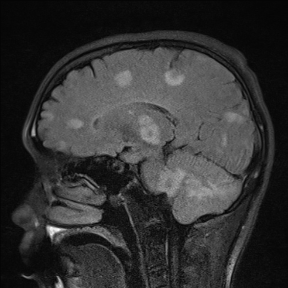 File:Cerebral toxoplasmosis (Radiopaedia 53993-60132 Sagittal FLAIR 12).jpg