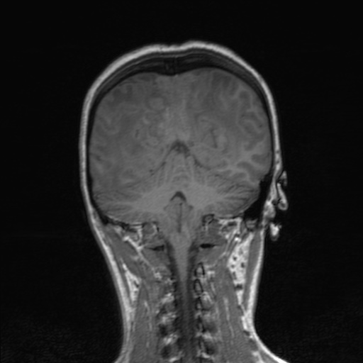 Cerebral tuberculosis with dural sinus invasion (Radiopaedia 60353-68090 Coronal T1 133).jpg