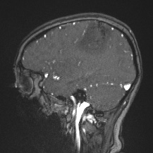 Cerebral venous infarction - hemorrhagic (Radiopaedia 81625-95505 Sagittal MRV 24).jpg