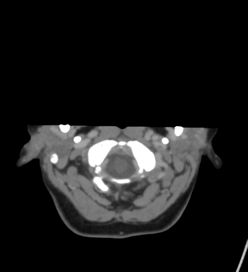 File:Cerebral venous infarction due to transverse sinus thrombosis (Radiopaedia 34688-36120 Axial CT venogram 5).png