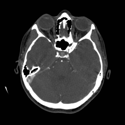 Cerebral venous sinus thrombosis (Radiopaedia 40619-43227 A 74).jpg