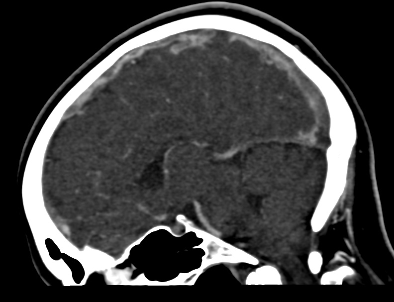 Cerebral venous sinus thrombosis (Radiopaedia 59224-66646 Sagittal C+ delayed 27).jpg
