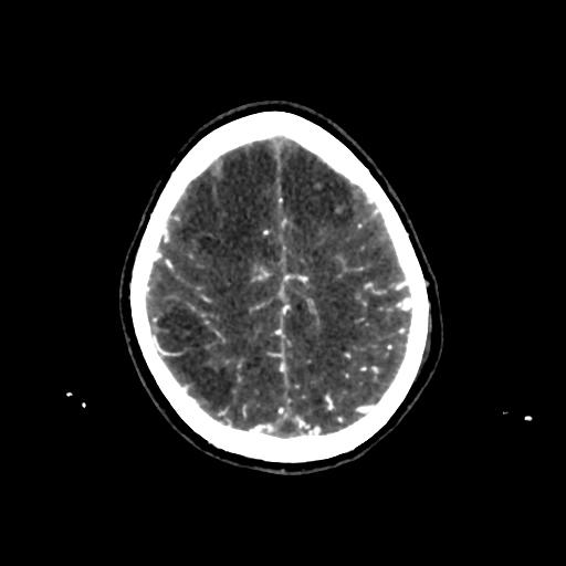 File:Cerebral venous throbmosis - hemorrhagic venous infarction (Radiopaedia 87318-103613 Axial CT venogram 30).jpg