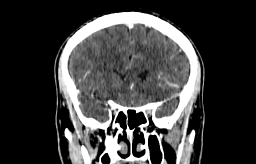 File:Cerebral venous thrombosis (CVT) (Radiopaedia 77524-89685 C 20).jpg