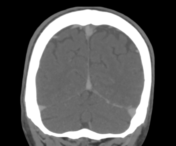 Cerebral venous thrombosis (Radiopaedia 38392-40467 Coronal CTA-Venogram 51).png