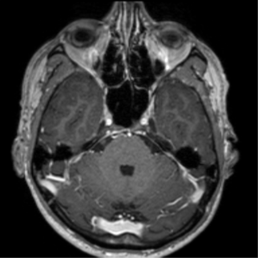 Cerebral venous thrombosis (Radiopaedia 38392-40469 Axial T1 C+ 25).png