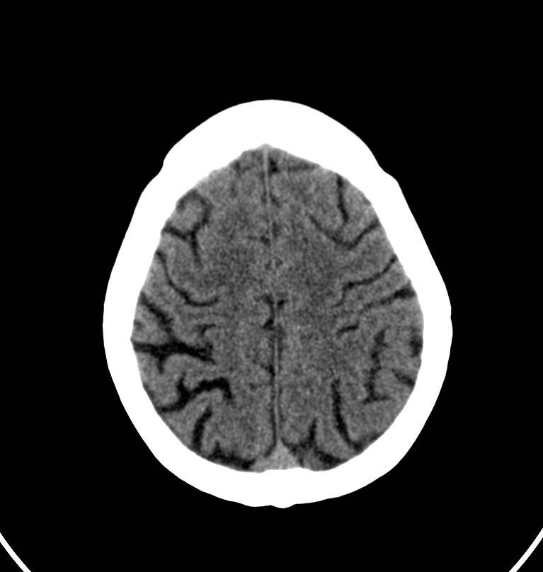 Cerebral venous thrombosis - CT only (Radiopaedia 41031-43778 Axial non-contrast 13).jpg