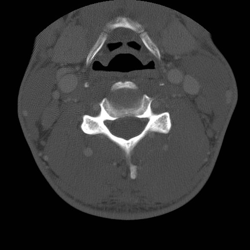 Cervical Pott disease (Radiopaedia 20374-20286 Axial bone window 78).jpg