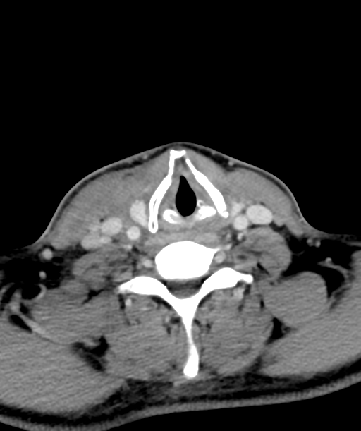 Cervical abscess (Radiopaedia 43725-47184 A 48).png