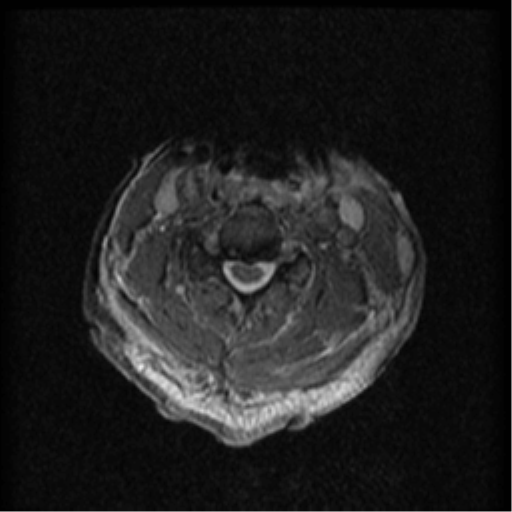 File:Cervical canal stenosis with cord compression (Radiopaedia 34114-35374 Axial Gradient Echo 52).png