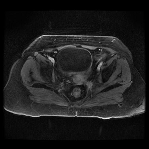 Cervical carcinoma (Radiopaedia 70924-81132 Axial T1 C+ fat sat 227).jpg