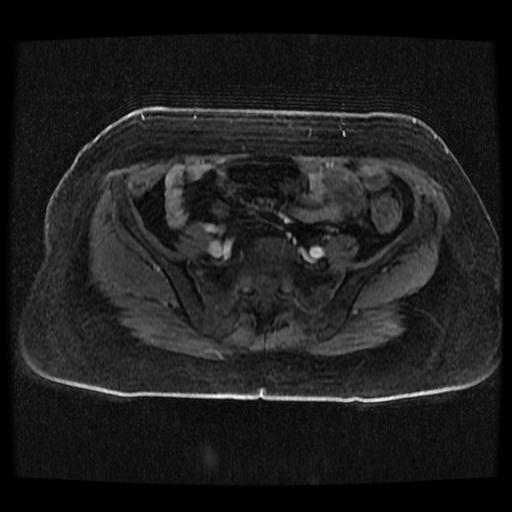 Cervical carcinoma (Radiopaedia 70924-81132 Axial T1 C+ fat sat 249).jpg