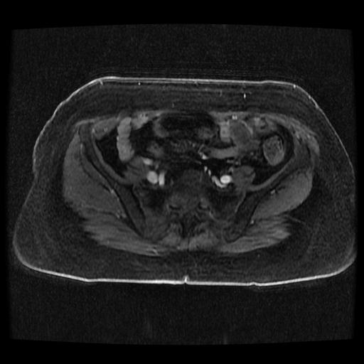 File:Cervical carcinoma (Radiopaedia 70924-81132 Axial T1 C+ fat sat 72).jpg