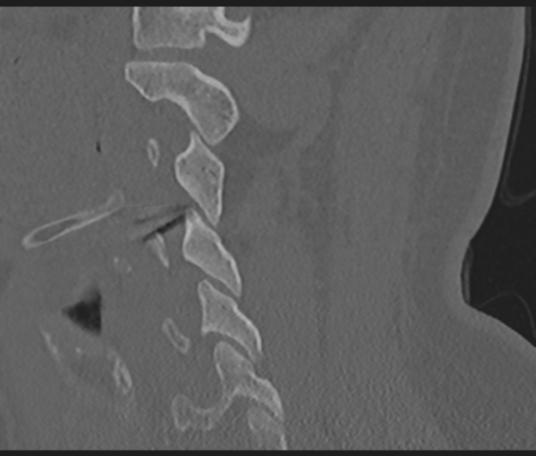 Cervical disc replacement (Radiopaedia 44025-47541 Sagittal bone window 55).png