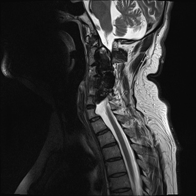 File:Cervical spinal neurofibroma in a patient with NF1 (Radiopaedia 58344-65465 Sagittal T2 7).jpg