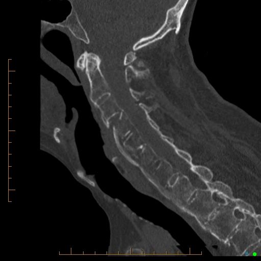 Cervical spine fracture - ankylosing spondylitis (Radiopaedia 76835-88706 Sagittal bone window 63).jpg