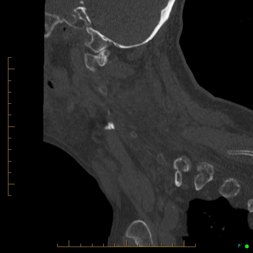 Cervical spine fracture - ankylosing spondylitis (Radiopaedia 76835-88706 Sagittal bone window 87).jpg