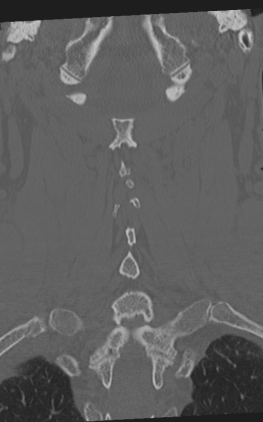 Cervical spine fractures with vertebral artery dissection (Radiopaedia 53296-59268 Coronal bone window 48).png