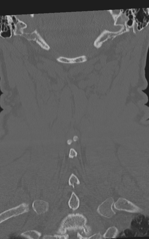 Cervical spine fractures with vertebral artery dissection (Radiopaedia 53296-59268 Coronal bone window 56).png