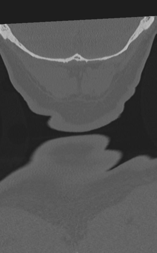 Cervical spine fractures with vertebral artery dissection (Radiopaedia 53296-59268 Coronal bone window 75).png