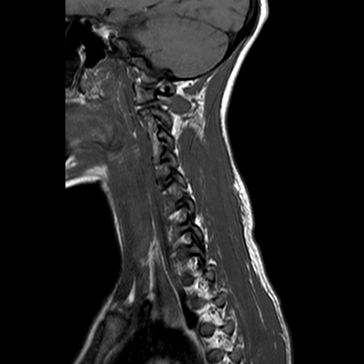 File:Cervical spine posterior ligamentous complex rupture (Radiopaedia 63486-72103 Sagittal T1 2).jpg