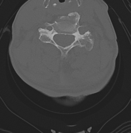 Cervical spondylolysis (Radiopaedia 49616-54811 Axial bone window 32).png