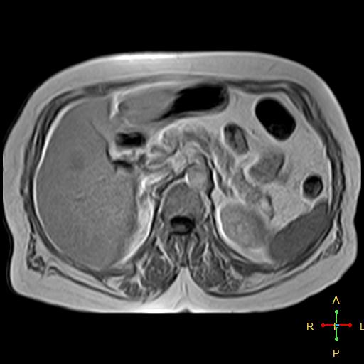 File:Cervical stump squamous cell carcinoma (Radiopaedia 48049-52858 H 7).jpg