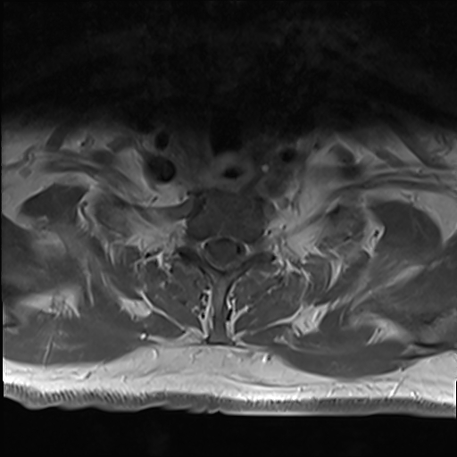 File:Cervical tumor-like myelopathy due to Type V dAVF (Radiopaedia 82461-96604 Axial T1 C+ fat sat 33).jpg