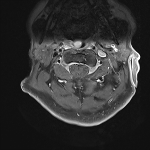 File:Cervical tumor-like myelopathy due to Type V dAVF (Radiopaedia 82461-96604 Axial T1 C+ fat sat 7).jpg