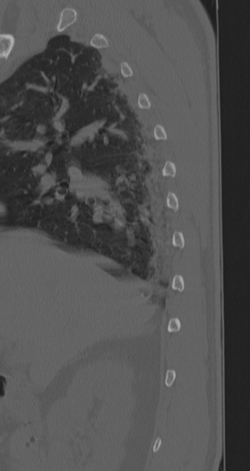 Chance fracture (Radiopaedia 33854-35020 Sagittal bone window 78).png