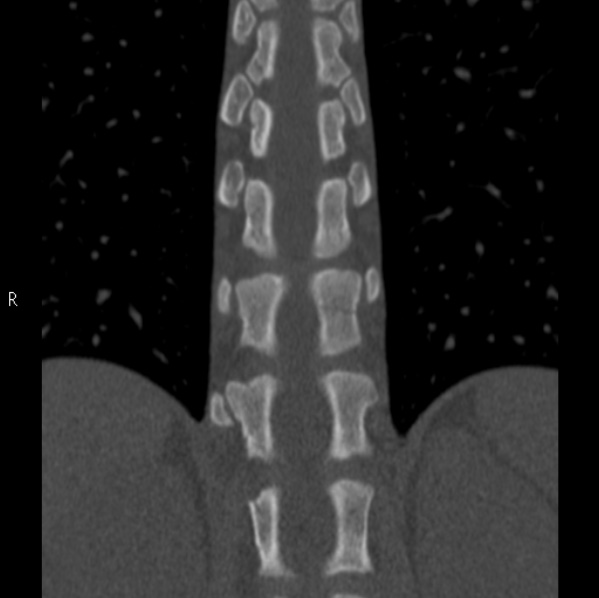 Chance fracture (Radiopaedia 36521-38081 Coronal bone window 32).jpg