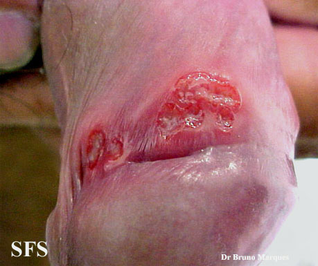 File:Chancroid (Dermatology Atlas 9).jpg