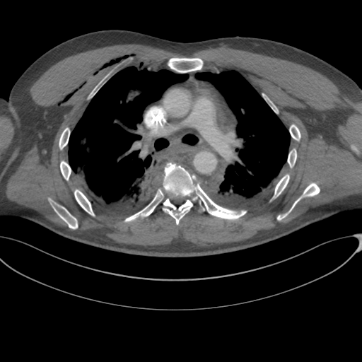 File:Chest multitrauma - aortic injury (Radiopaedia 34708-36147 A 124).png