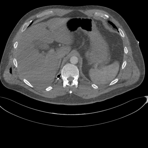 File:Chest multitrauma - aortic injury (Radiopaedia 34708-36147 A 281).png