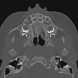 Choanal atresia (Radiopaedia 88525-105975 Axial bone window 16).jpg