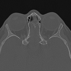 Choanal atresia (Radiopaedia 88525-105975 Axial bone window 98).jpg