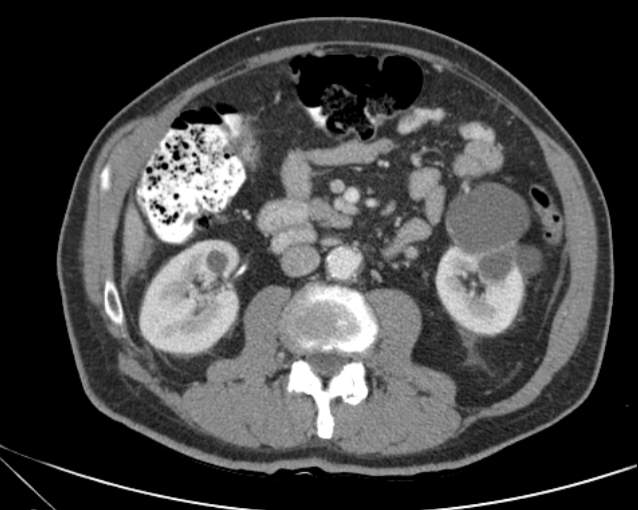 Cholecystitis - perforated gallbladder (Radiopaedia 57038-63916 A 42).jpg
