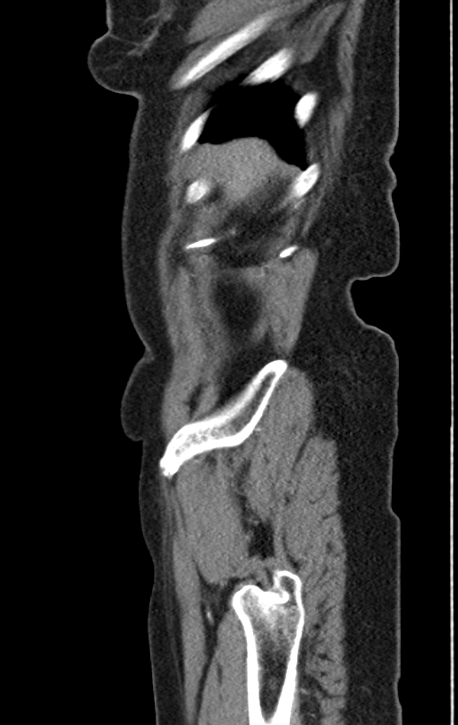 Cholecystoduodenal fistula due to calculous cholecystitis with gallstone migration (Radiopaedia 86875-103077 C 57).jpg