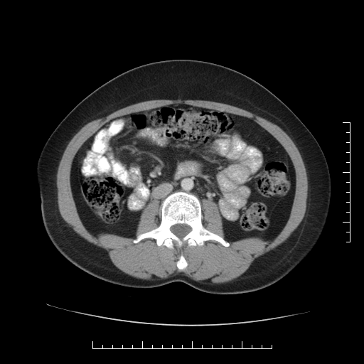 File:Choledochal cyst with chronic calcific pancreatitis (Radiopaedia 18245-18061 A 21).png