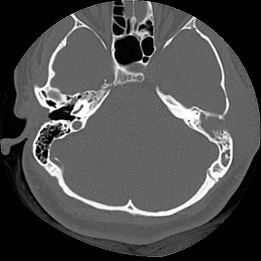 Cholesteatoma (Radiopaedia 84960-100474 Axial bone window 40).jpg