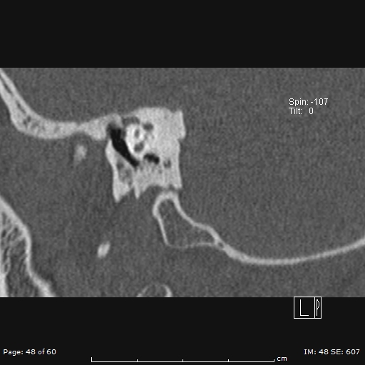 Cholesteatoma - external auditory canal (Radiopaedia 88452-105096 Sagittal bone window 48).jpg