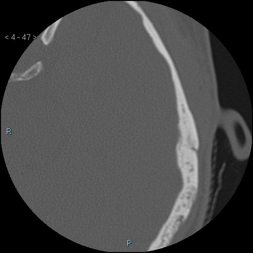 Cholesterol granuloma of the petrous apex (Radiopaedia 64358-73141 Axial bone window 23).jpg